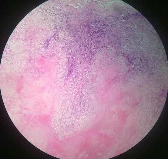 caseous necrosis histology