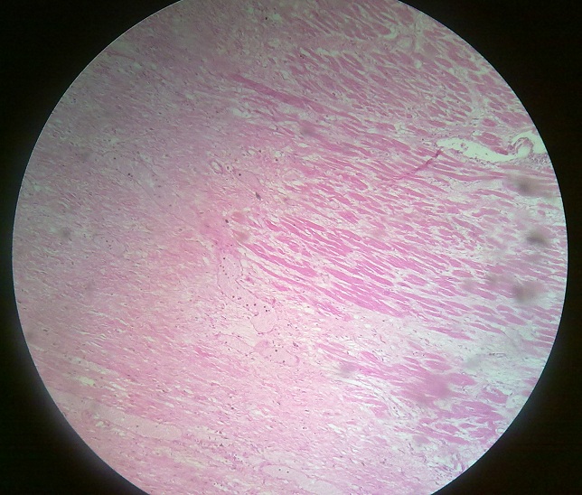 coagulative necrosis liver