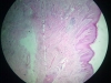 granulation-tissue-2