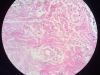 granulation-tissue-3
