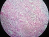 granulation-tissue-5