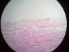 granulation-tissue-6