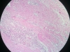 granulation-tissue-7