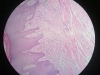 granulation-tissue-8