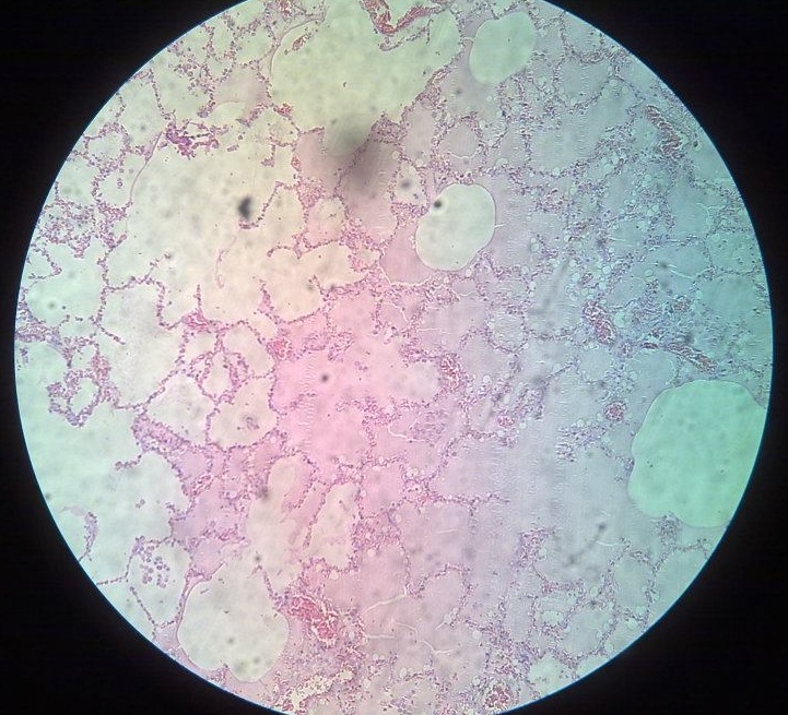 pulmonary edema histology macrophages