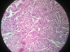 squamous-cell-carcinoma-2