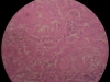squamous-cell-carcinoma-3-40x