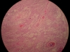 squamous-cell-carcinoma-10x