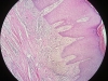 granulation-tissue-1