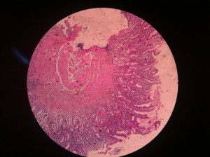 H.pylori Associated Chronic Gastritis 10X