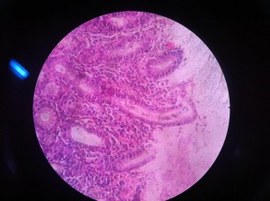 H.pylori Associated Chronic Gastritis 40X